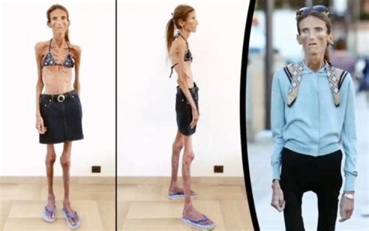 Skinniest Person in the World: Facts and Stories |